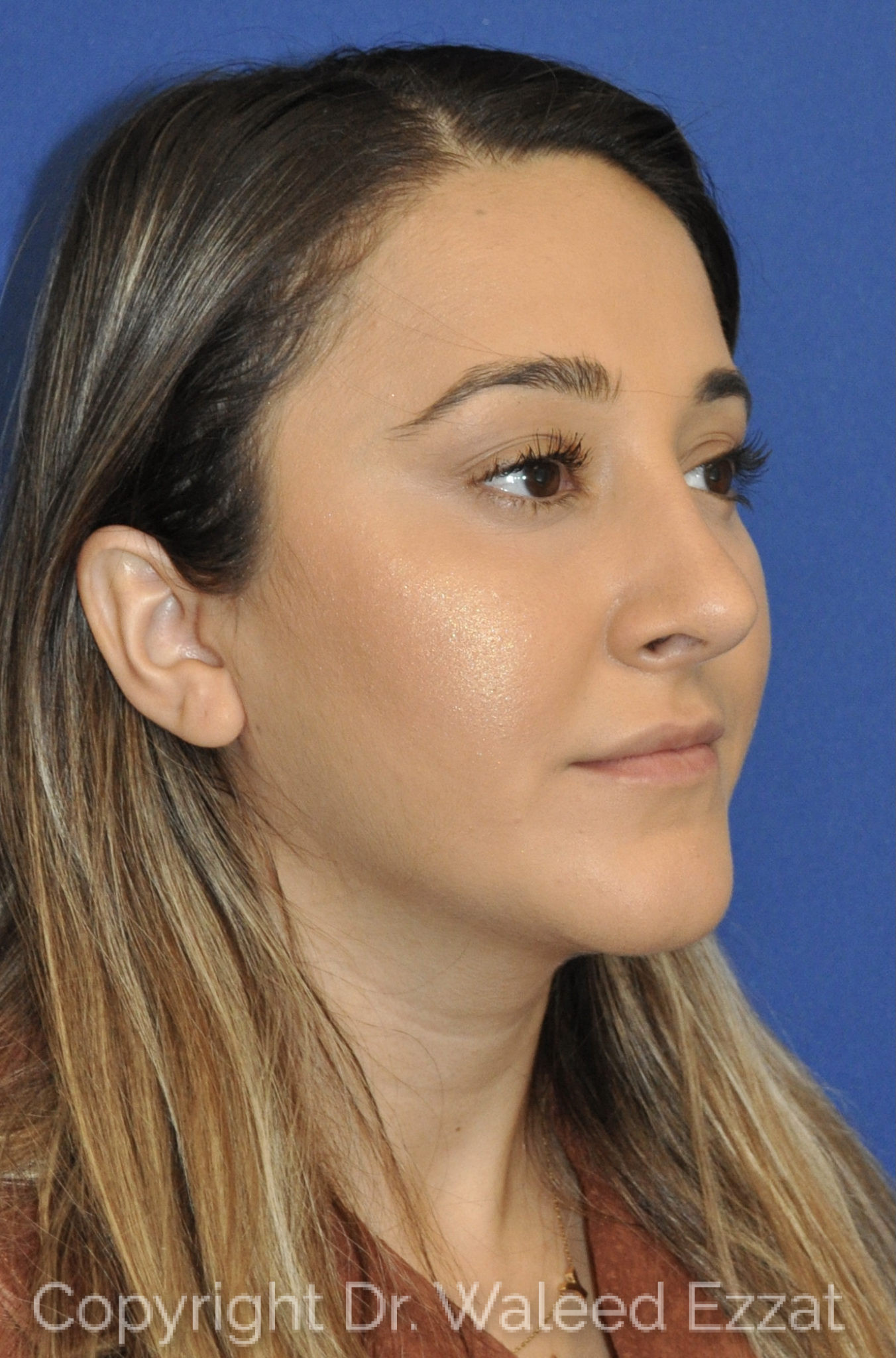 Hispanic/South American Rhinoplasty Patient Photo - Case 31 - after view-1