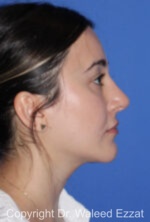 Hispanic/South American Rhinoplasty - Case 294 - After