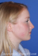 Caucasian/European Rhinoplasty - Case 349 - After