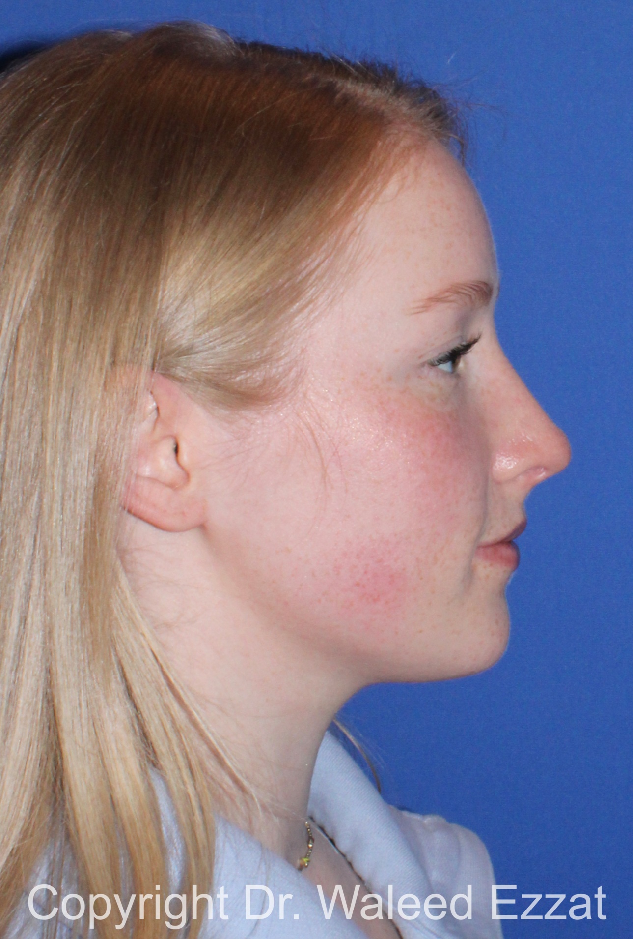 Caucasian/European Rhinoplasty Patient Photo - Case 349 - after view