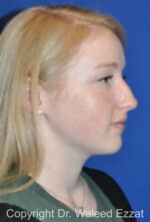 Caucasian/European Rhinoplasty - Case 349 - Before