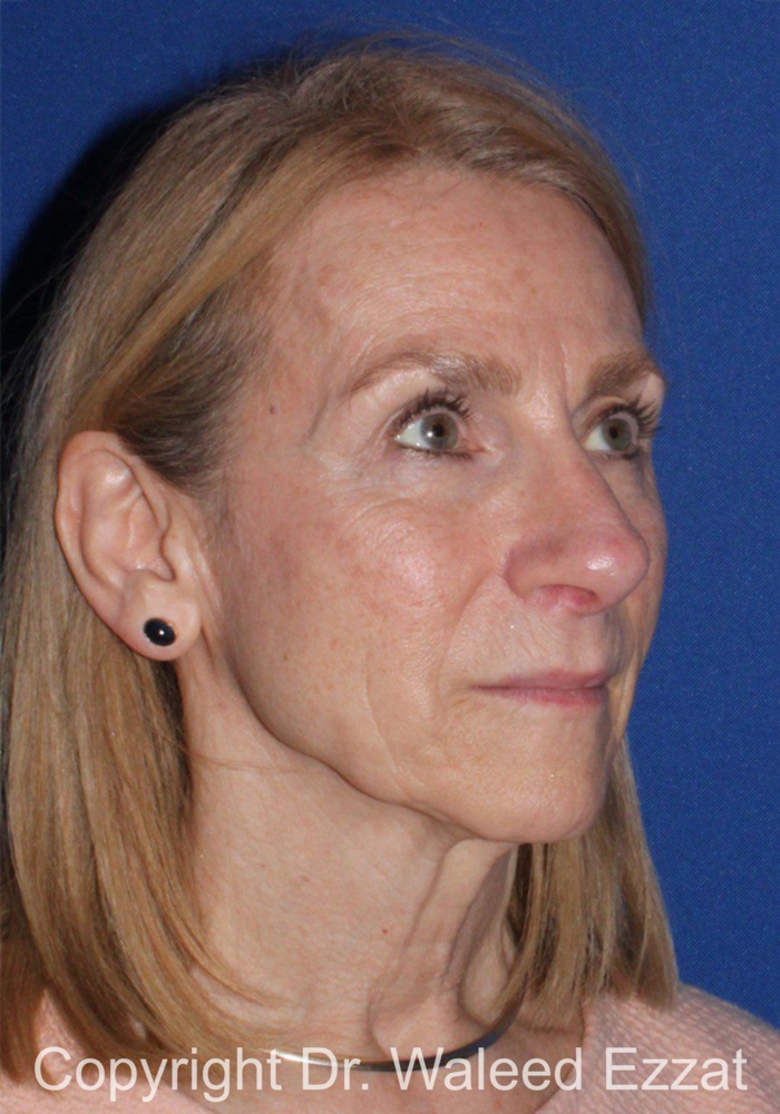 Facelift Patient Photo - Case 1 - before view-1