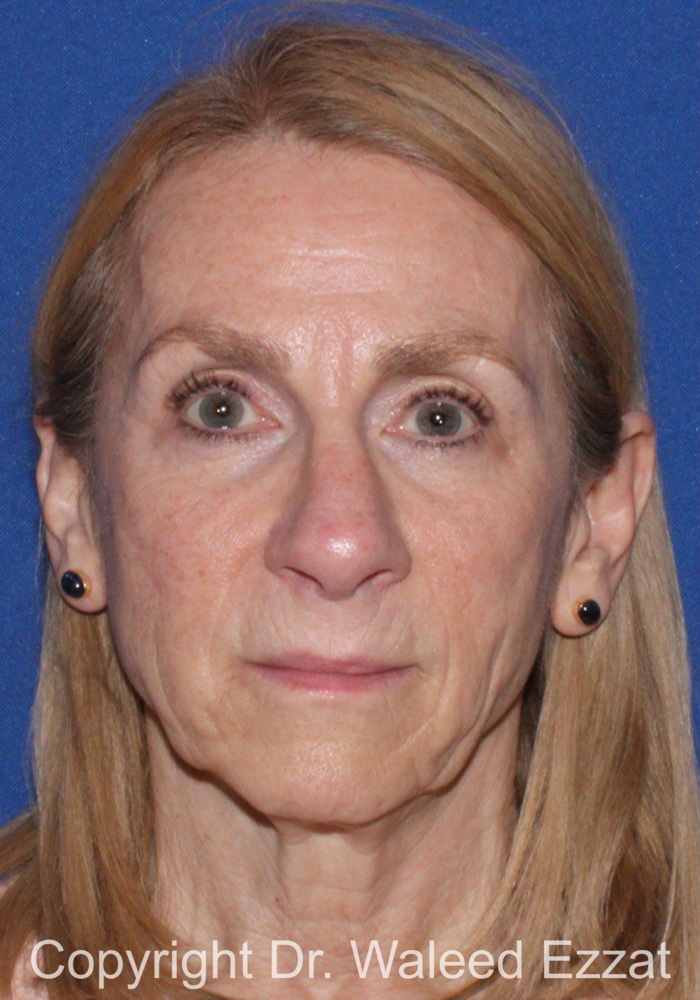 Facelift Patient Photo - Case 1 - before view-2