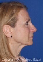 Brow Lift - Case 1 - Before