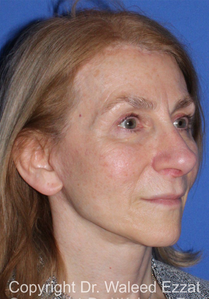 Facelift Patient Photo - Case 1 - after view-1