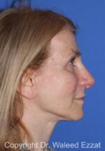 Brow Lift - Case 1 - After