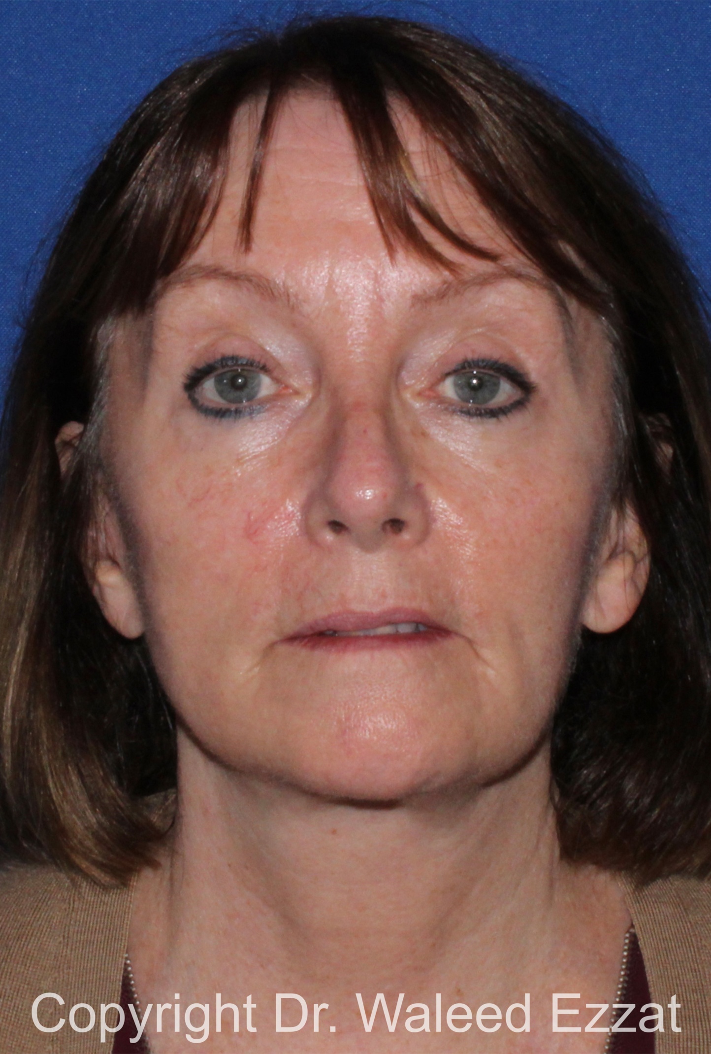 Cheek Lift Patient Photo - Case 4 - after view-2