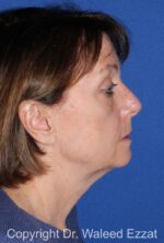 Cheek Lift - Case 4 - Before