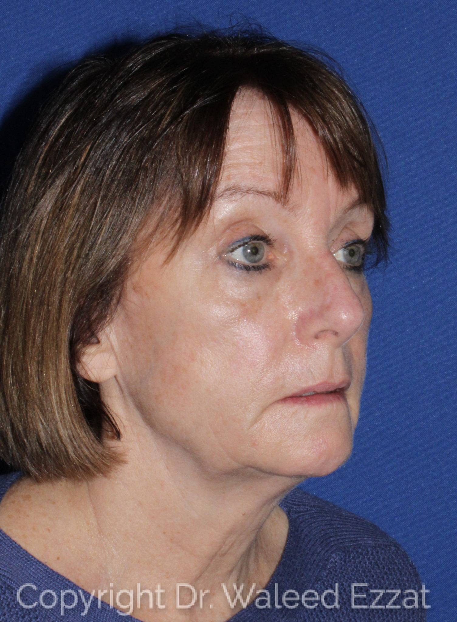 Neck Lift Patient Photo - Case 3 - before view-1