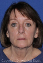 Blepharoplasty - Case 3 - Before