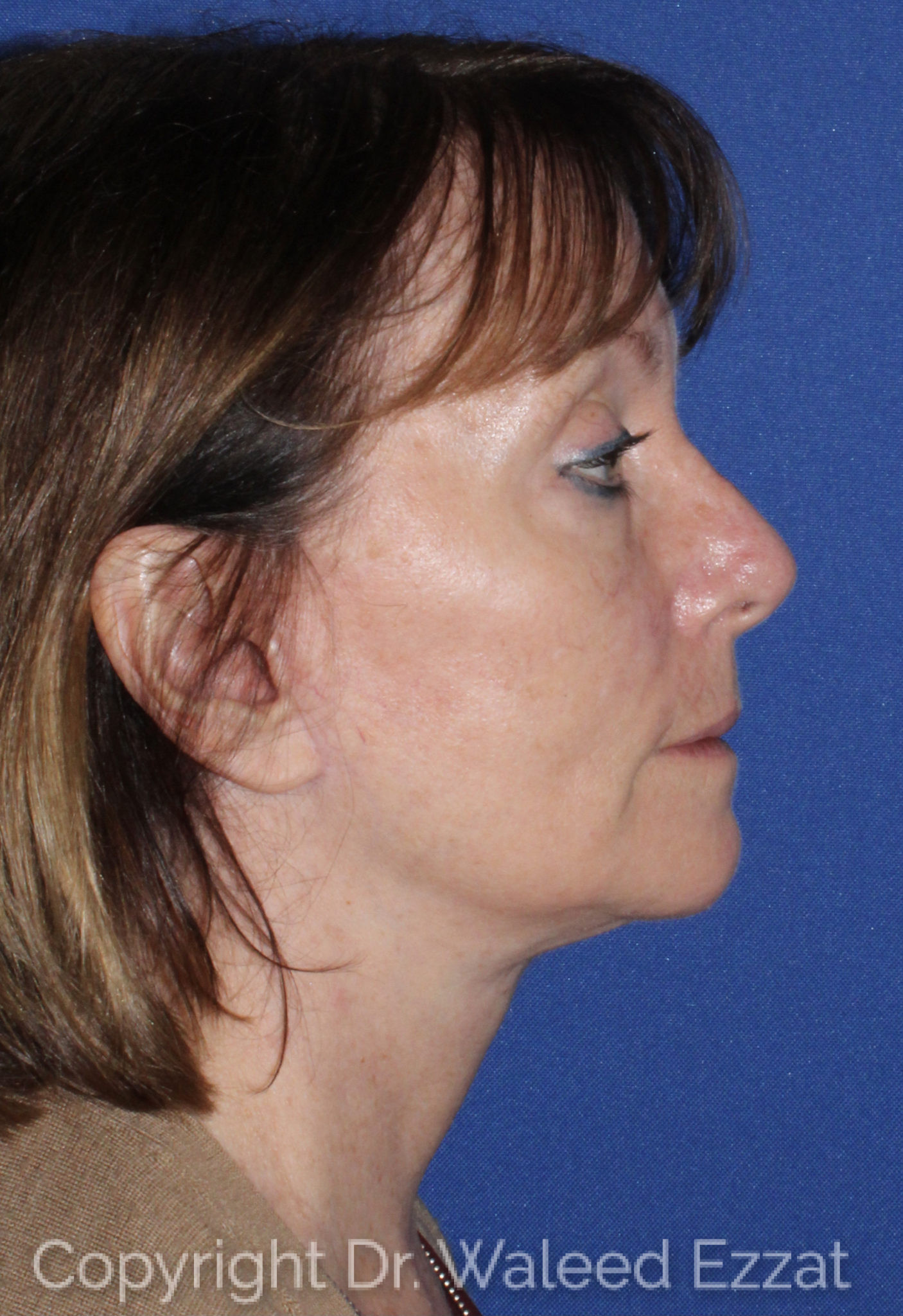 Neck Lift Patient Photo - Case 3 - after view-2