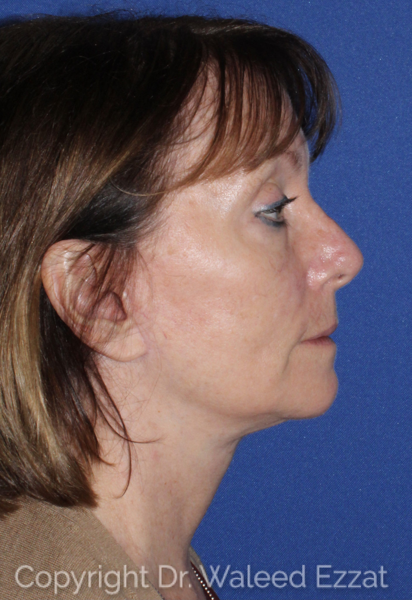 Blepharoplasty Patient Photo - Case 3 - after view-2