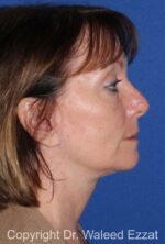Cheek Lift - Case 4 - After