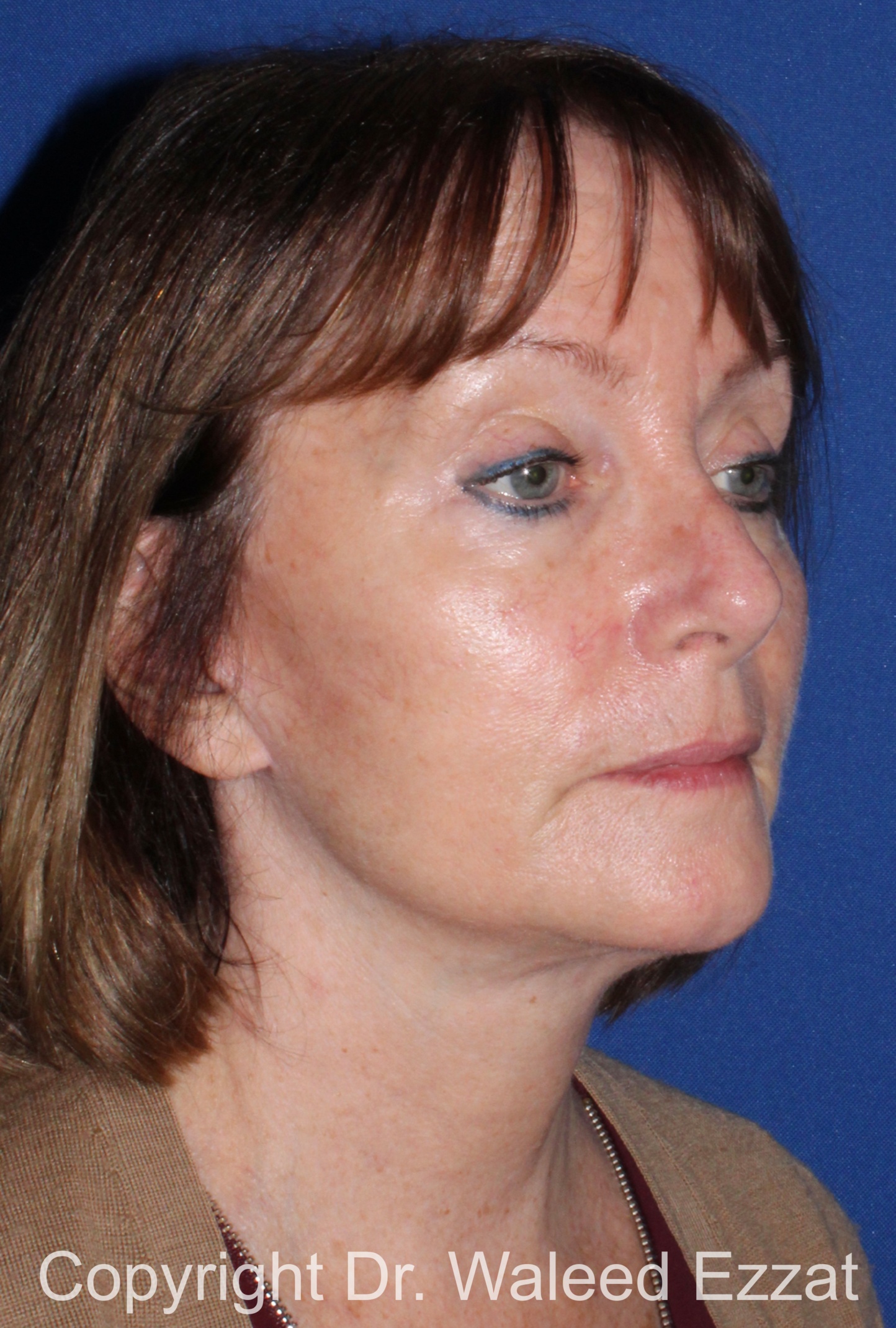 Cheek Lift Patient Photo - Case 4 - after view-1