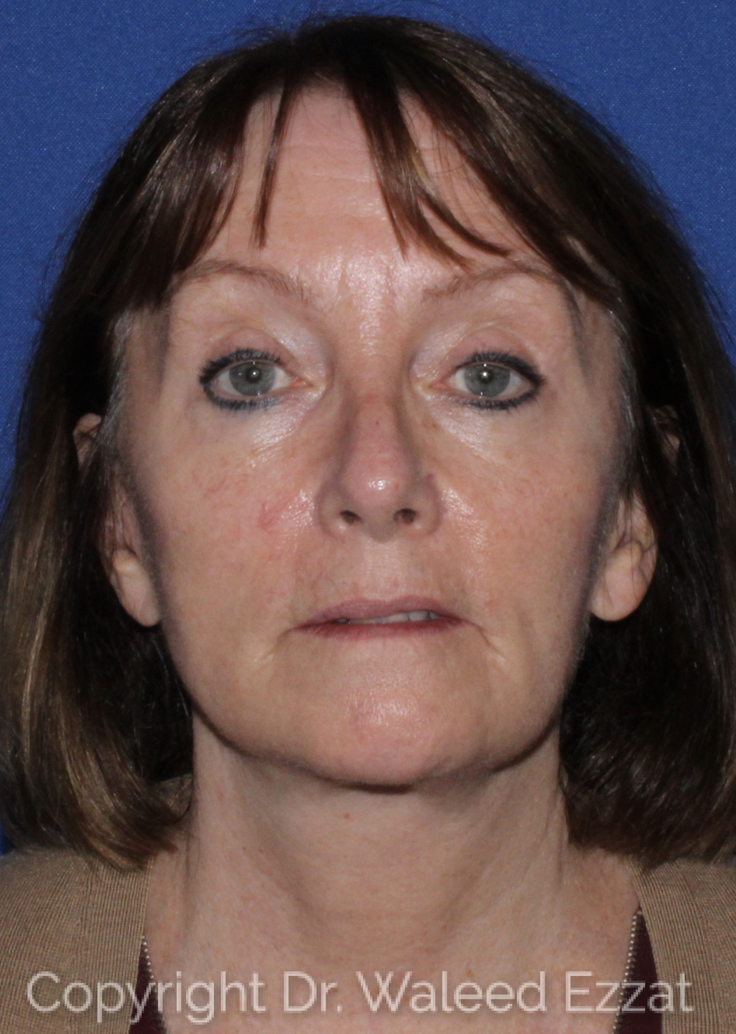Blepharoplasty Patient Photo - Case 3 - after view