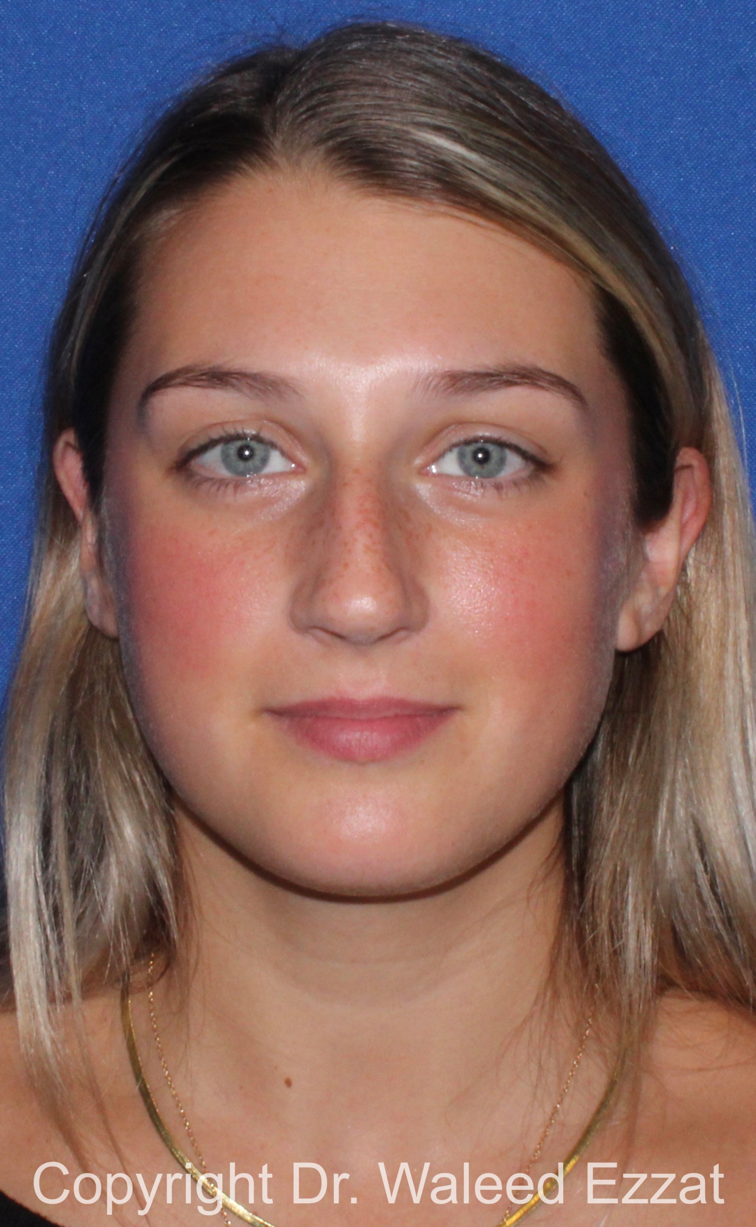 Caucasian/European Rhinoplasty Patient Photo - Case 96 - before view-2