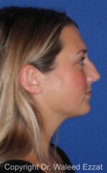 Caucasian/European Rhinoplasty - Case 96 - Before