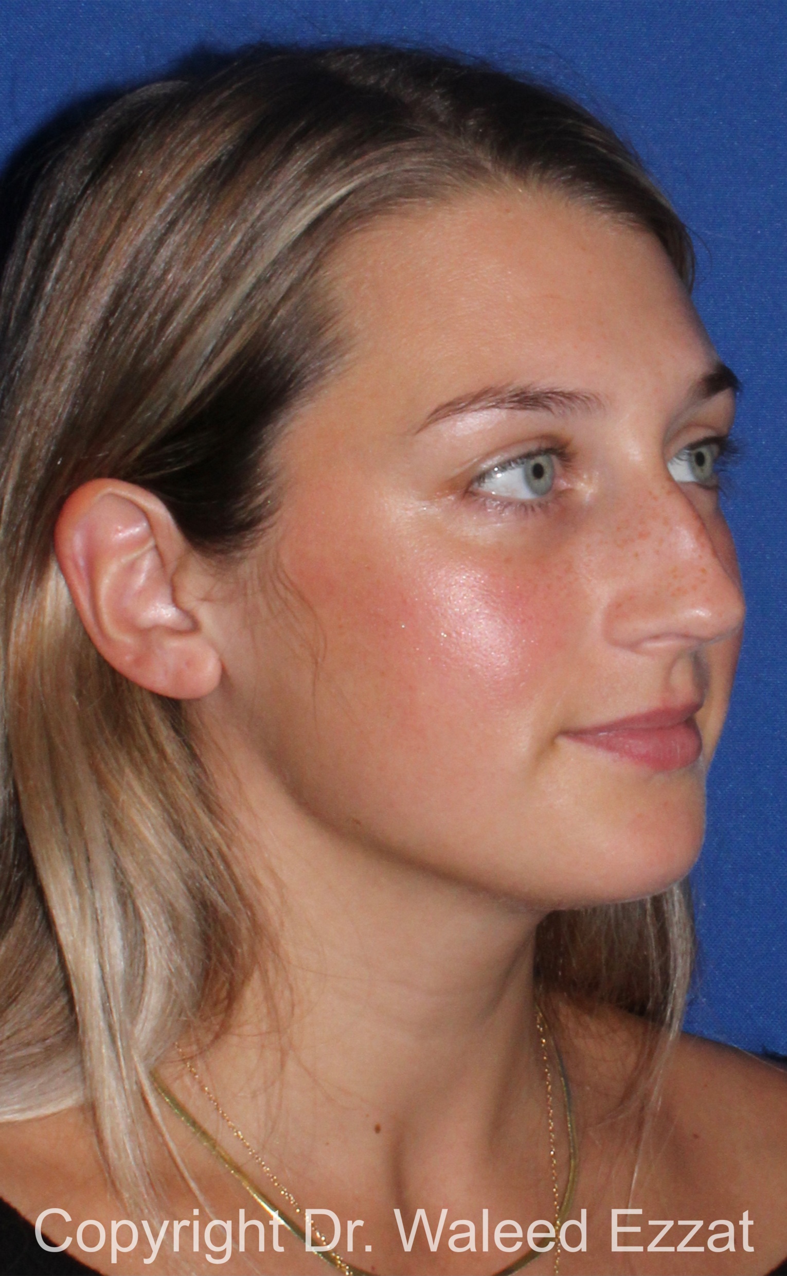 Caucasian/European Rhinoplasty Patient Photo - Case 96 - before view-1