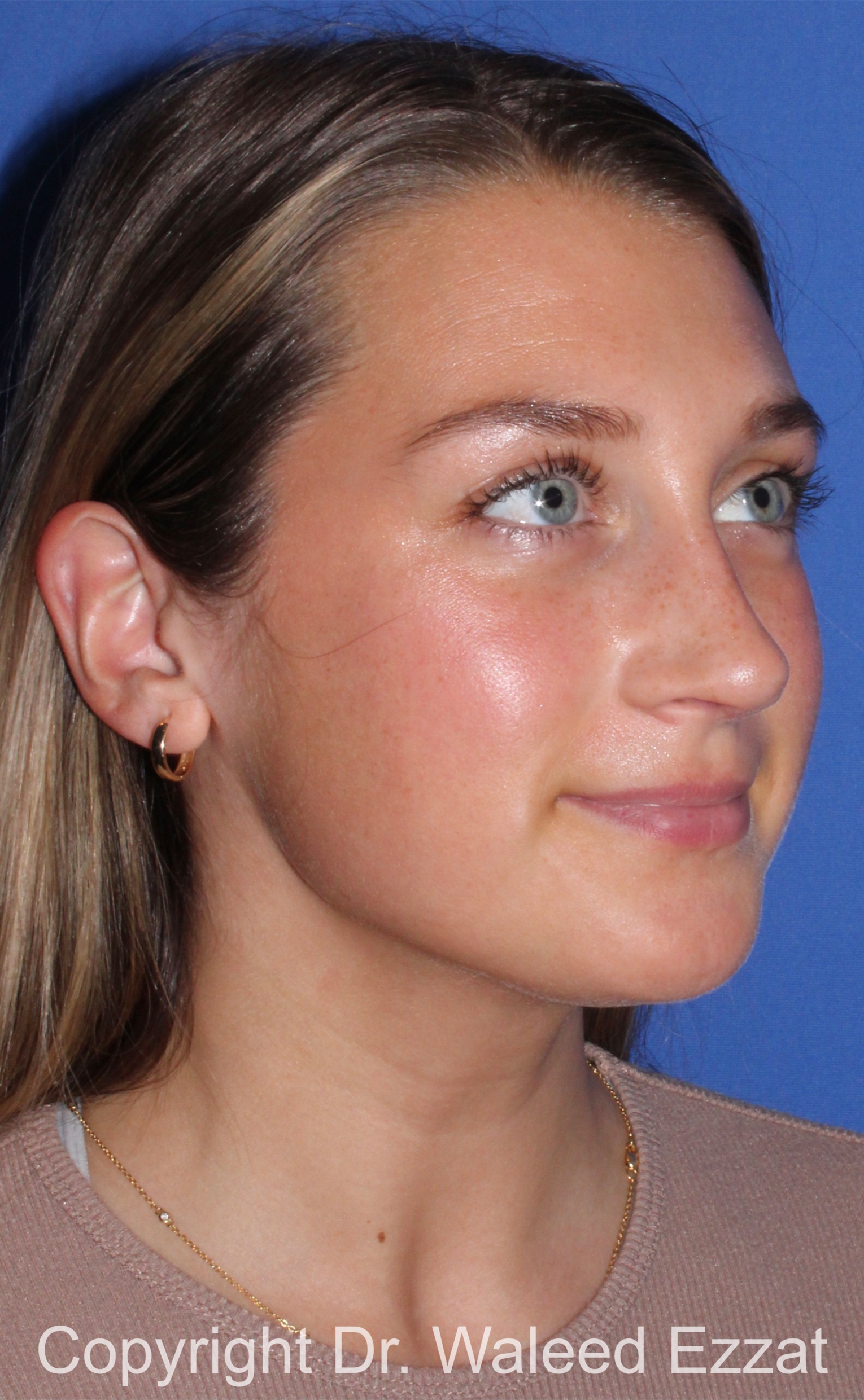 Caucasian/European Rhinoplasty Patient Photo - Case 96 - after view-1