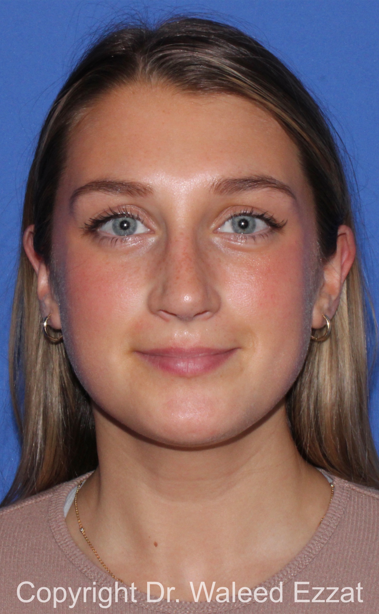 Caucasian/European Rhinoplasty Patient Photo - Case 96 - after view-2