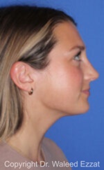 Caucasian/European Rhinoplasty - Case 96 - After