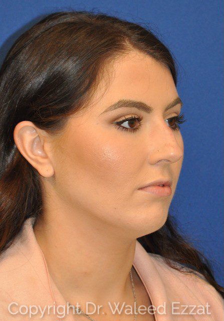 Hispanic/South American Rhinoplasty Patient Photo - Case 35 - before view-1