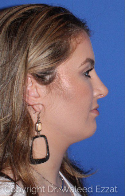 Hispanic/South American Rhinoplasty Patient Photo - Case 35 - after view