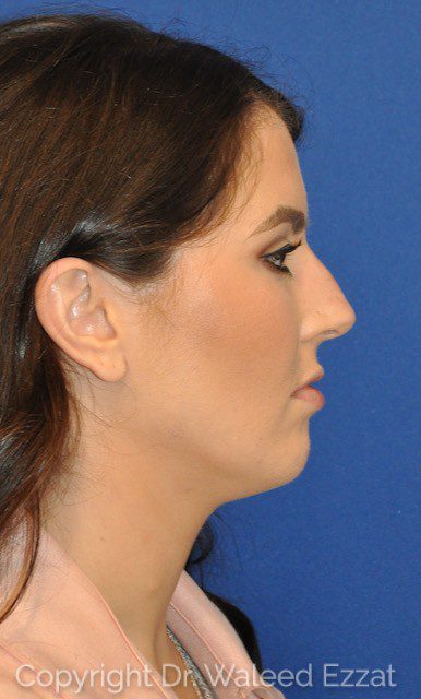 Hispanic/South American Rhinoplasty Patient Photo - Case 35 - before view-