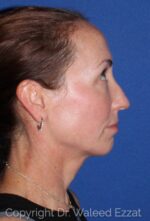 Caucasian/European Rhinoplasty - Case 36 - Before