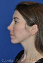 Caucasian/European Rhinoplasty - Case 115 - Before