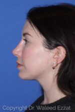 Caucasian/European Rhinoplasty - Case 115 - After