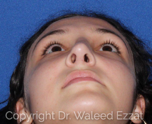 Mediterranean/Middle Eastern Rhinoplasty Patient Photo - Case 116 - after view-2