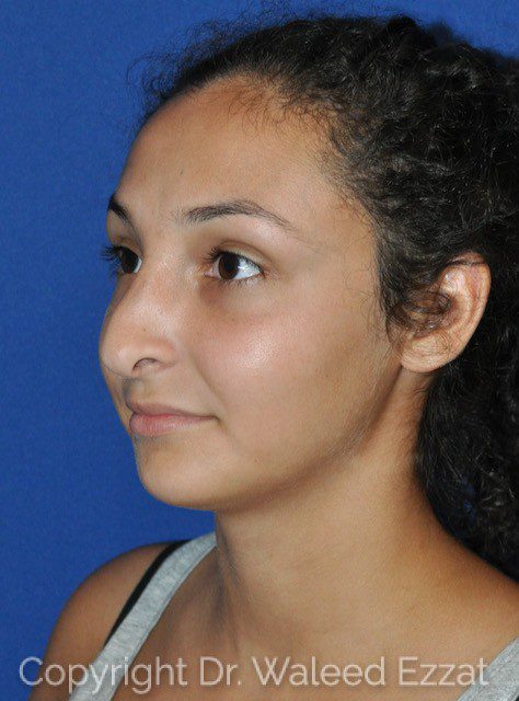 Mediterranean/Middle Eastern Rhinoplasty Patient Photo - Case 116 - before view-1