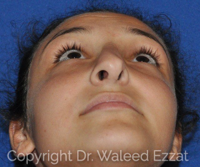 Mediterranean/Middle Eastern Rhinoplasty Patient Photo - Case 116 - before view-2