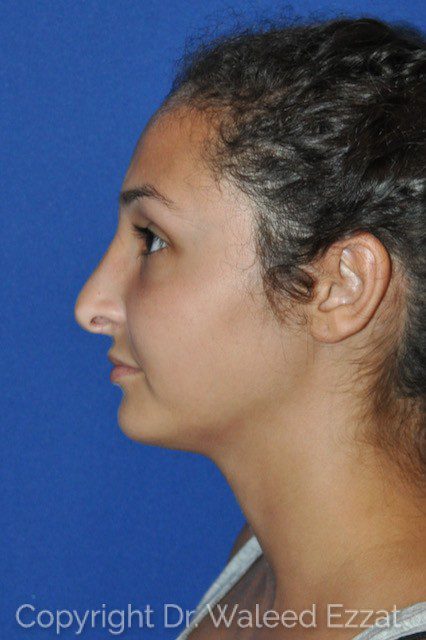 Mediterranean/Middle Eastern Rhinoplasty Patient Photo - Case 116 - before view-