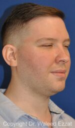 Buccal Fat Excision - Case 22 - Before