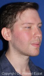 Buccal Fat Excision - Case 22 - After