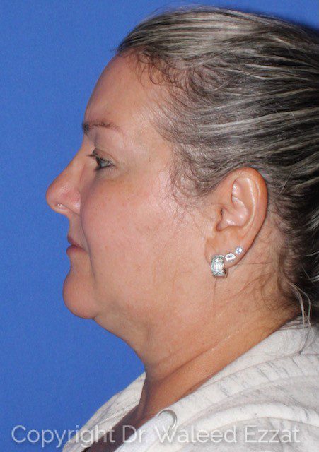 Facial Contouring Patient Photo - Case 2 - after view-2