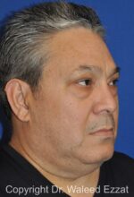 Blepharoplasty - Case 13 - Before