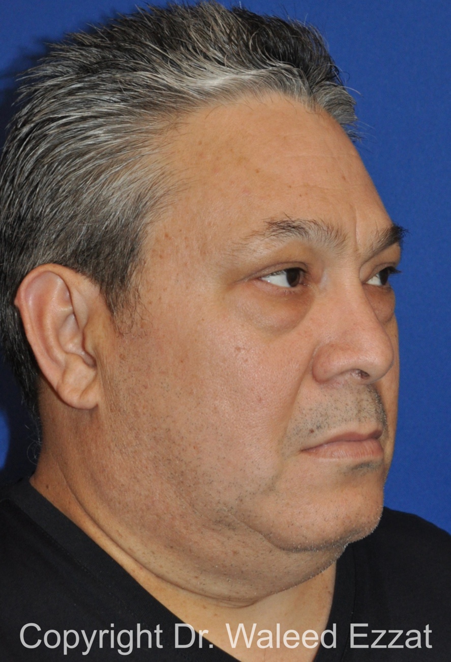 Blepharoplasty Patient Photo - Case 13 - before view-