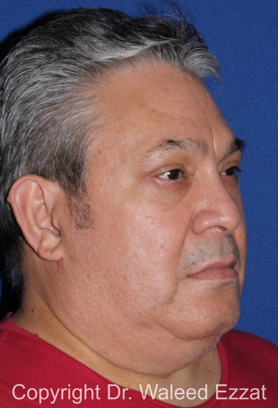 Blepharoplasty Patient Photo - Case 13 - after view