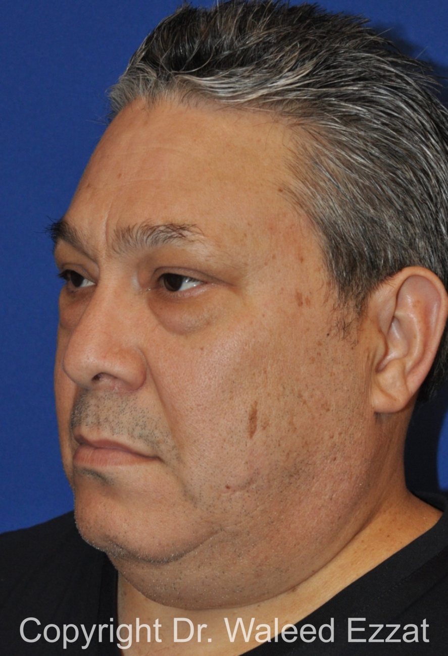 Blepharoplasty Patient Photo - Case 13 - before view-1