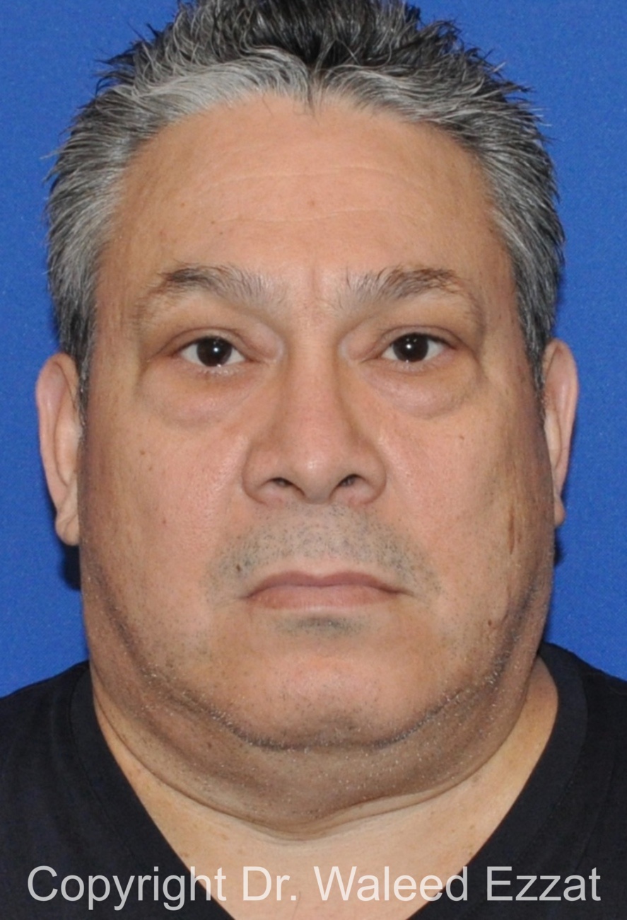 Blepharoplasty Patient Photo - Case 13 - before view-2