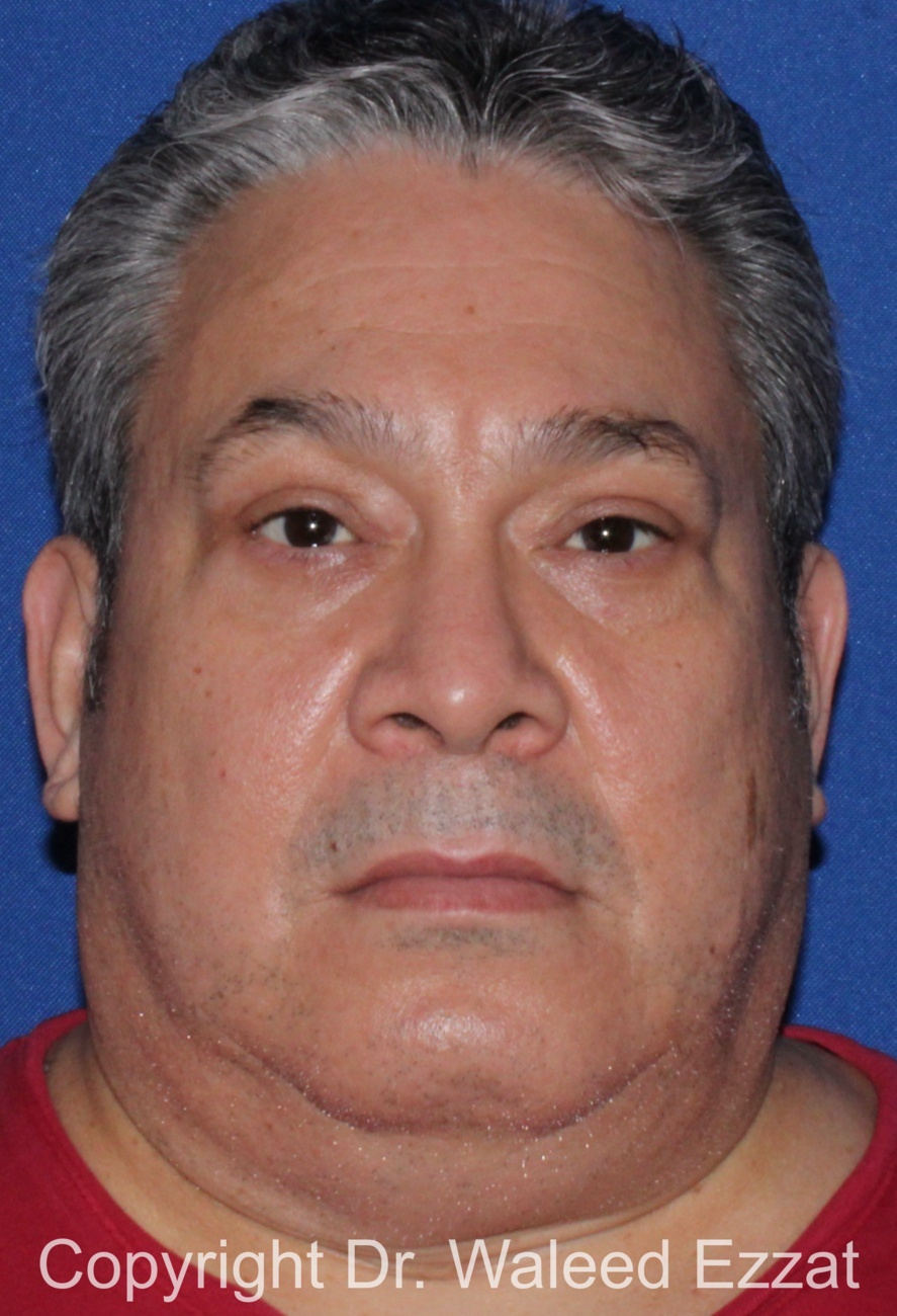 Blepharoplasty Patient Photo - Case 13 - after view-2