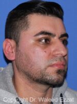 Blepharoplasty - Case 15 - After