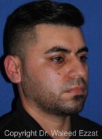 Blepharoplasty - Case 15 - Before