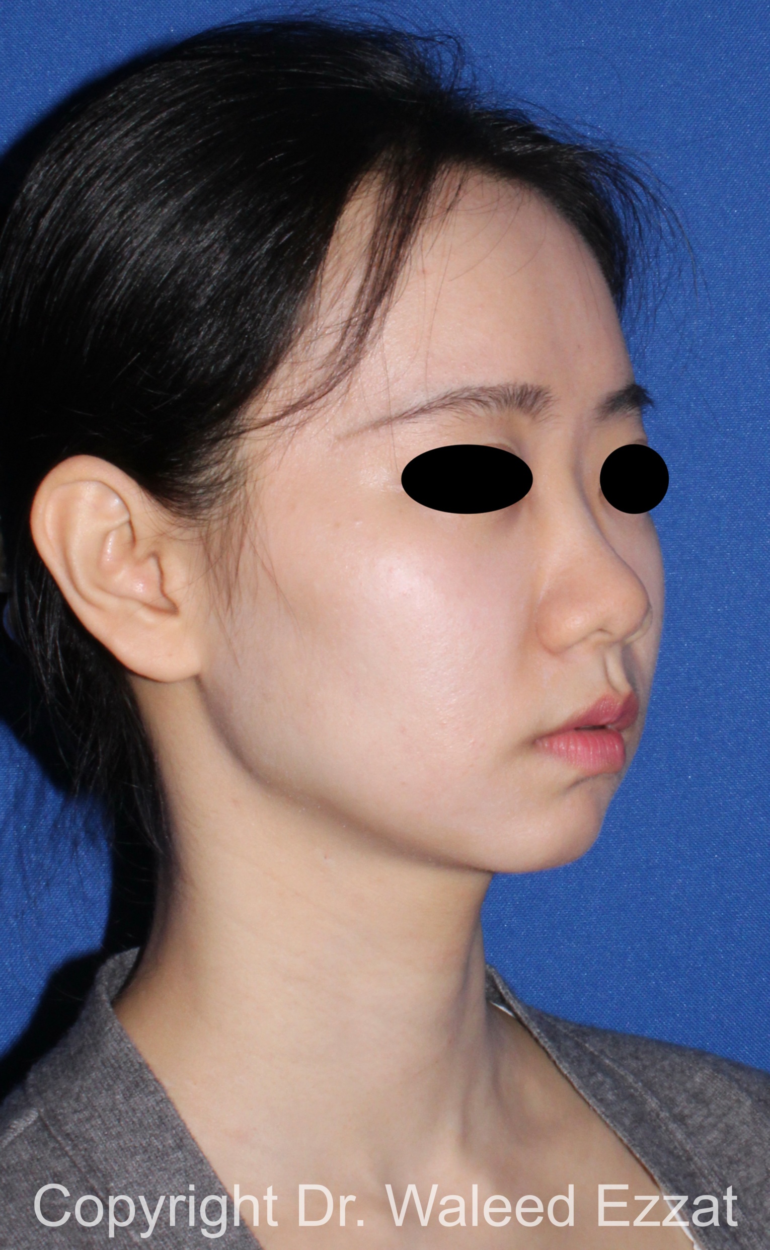 Rhinoplasty Patient Photo - Case 216 - before view-1