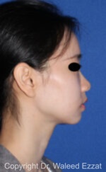 East Asian Rhinoplasty - Case 216 - Before