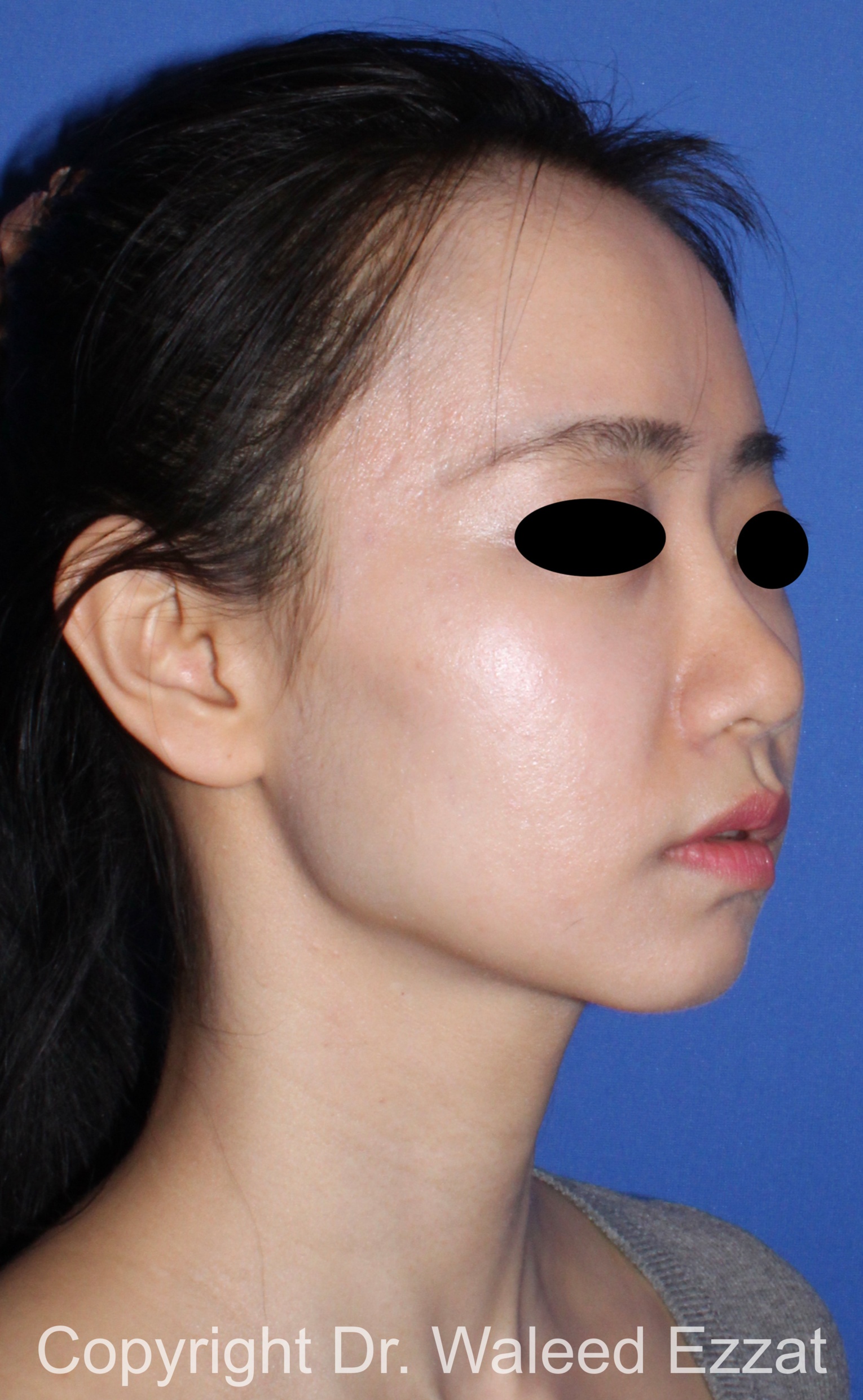 Rhinoplasty Patient Photo - Case 216 - after view-1