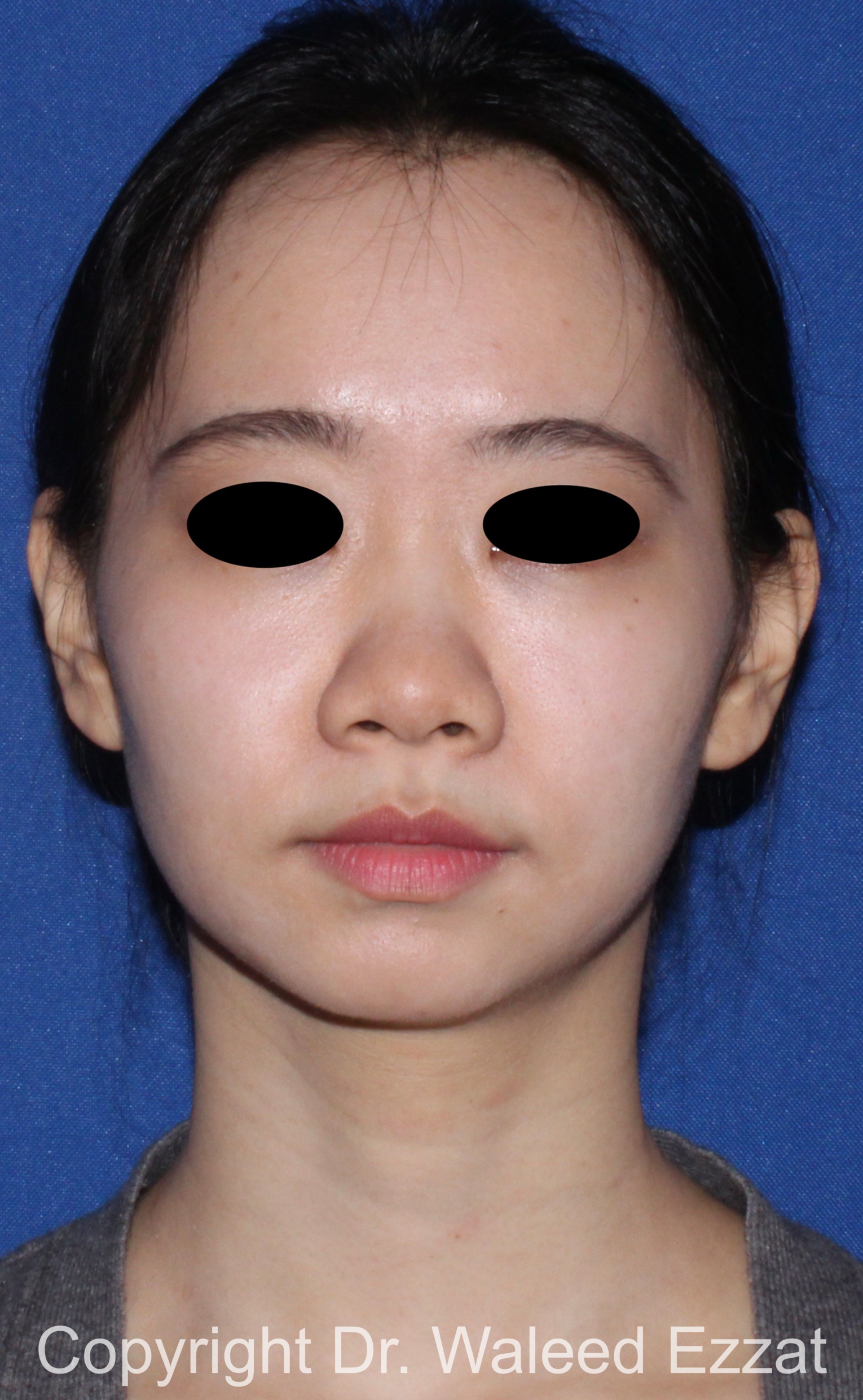 Rhinoplasty Patient Photo - Case 216 - before view-2